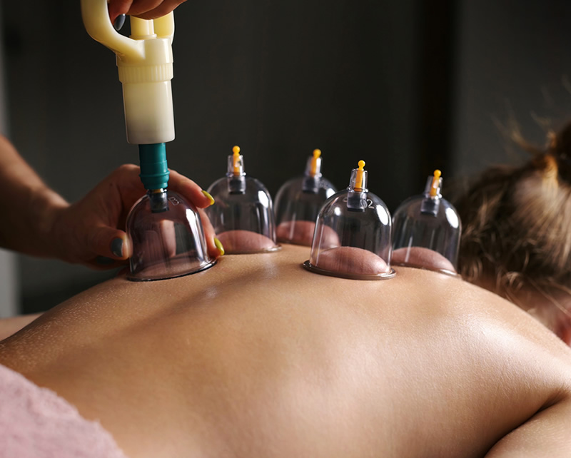 Cupping Therapy